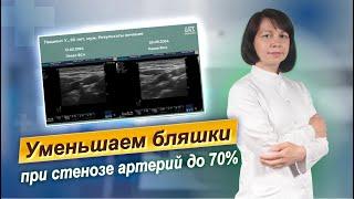 Бляшки в сосудах шеи до 70%. Медицинский кейс.