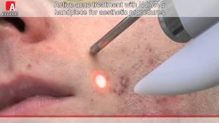 ACNE VULGARIS TREATMENT Fotona Lightwalker Nd:YAG laser