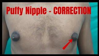 Puffy nipples surgery| Treatment of puffy nipples condition| Scarless correction of puffy nipples