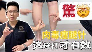 ️肉毒瘦腿針如何施打才有效？永久告別粗壯小腿