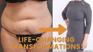 Liposuction Before & Afters | Sono Bello