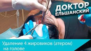 Удаление 4 жировиков (атером) на голове. Removal of 4 cysts on the head