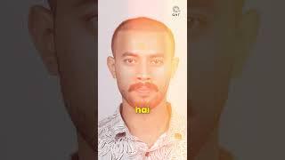 One Months Hair Transplant Progress | Latest Fue Technique #shorts #viral #hair transplant