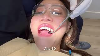 $40 teeth cleaning at Brighter Dental in #losangeles #california #teethcleaning #vlog #asmr #teeth