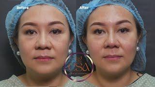 How to achieve a nose line make up effect w/ PDO nose threads , +New Rejuran Healer for Ageless Skin