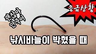 3초만에 낚시바늘 제거방법 / 낚시인이라면 알아두어야 할 응급처치