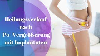 Gesäßaugmentation/ Po-Vergrößerung mit Implantaten / Brazilian Butt Lift - die komplette Operation