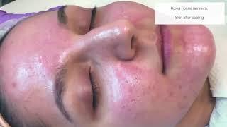 Enzyme Acid Peel CLA from ONmacabim for post acne