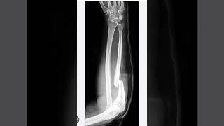 montagia fracture #xrayclasses #radiologyresidency #radiology #xray #radiologycareer #xrayclasses