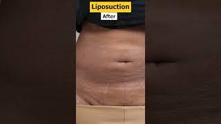 Abdomen Liposuction Before and After result #shorts