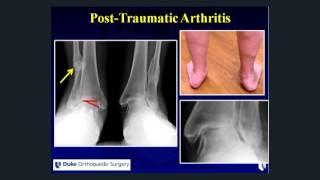 Ankle Arthritis