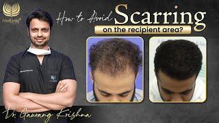 Scarring on Recipient Area HAIR TRANSPLANT GONE WRONG Best Hair Transplant in India | Medlinks