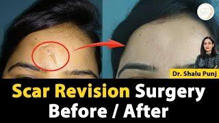 Scar Revision Surgery Before and After "Spark Clinique"  #scarrevision #plasticsurgeon