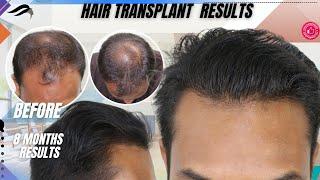 Hair Transplant In Pune | Best Cost Surgeon Clinic & Results of Hair transplant In Pune