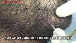 Electrolysis of man beard (white hairs)