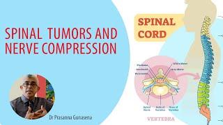 Spinal Tumors | Dr Prasanna Gunasena