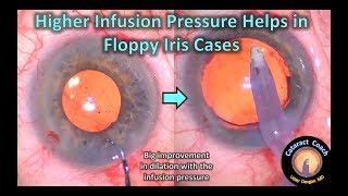 Higher Infusion Pressure Helps in Floppy Iris Cataract Surgery