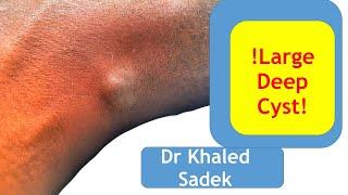 10 year old neck cyst removed. Dr Khaled Sadek. London Cyst Clinic