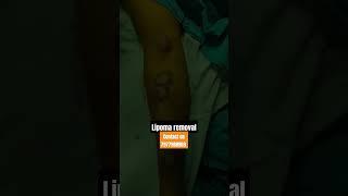 lipoma removal #lipomatreatment #lipoma #pimplepopper . contact on 7977988969 Dr Vicky Jain