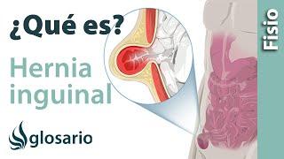 HERNIA INGUINAL | Qué es, qué afecta, síntomas, , causas y tratamiento fisioterapéutico