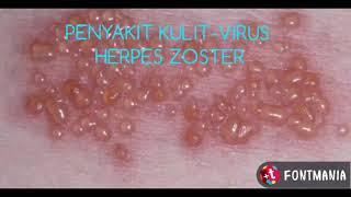 HERPES ZOSTER, SKIN DISSEASE / PENYAKIT KULIT