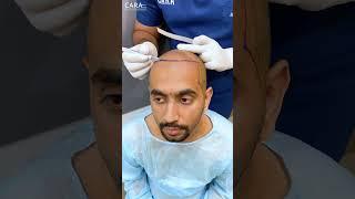 Discover Cara Clinic's AFFORDABLE Hair Transplant Solutions in India!