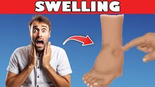 Vitamin to Eliminate Swollen Legs and Ankles | Kidney Failure Symtom