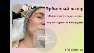 Эрбиевый лазер: шлифовка лица до и после