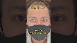 全切開二重術直後です。切開二重は通常2週間程度のダウンタイムで3〜6ヶ月後に完成です。腫れが少なければ埋没並みの腫れですね！#全切開 #切開二重 #二重整形