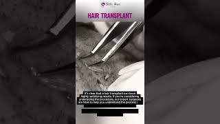 Hair Transplant | Regain your hair and confidence with minimal downtime | #hairtransplant #shorts