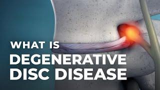 Lumbar Degenerative Disc Disease | Atlantic Spine Center