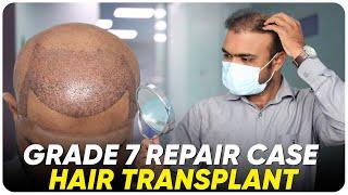 Hair Transplant in Ratlam | Best Results & Cost of Hair Transplant in Ratlam