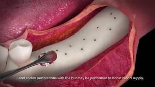 3D dental video - Bone augmentation in complex bone defects (Parte II) - Trailer