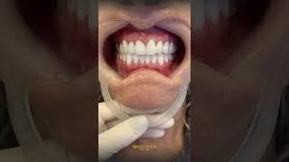 Dental Implants in Turkey - Dental Surgery at Best Price | Tower Dental Clinic