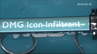 Infiltration an Schmelzfrakturen mit ICON iDentis Dr-Wilde