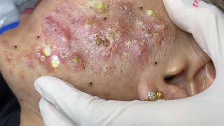 Big Cystic Acne Blackheads Extraction Blackheads & Milia, Whiteheads Removal Pimple Popping # 1565