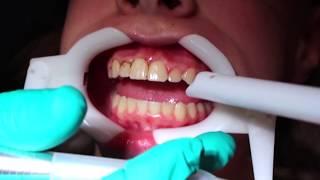 Gingival Recontouring (Reshaping the gum tissue with a laser)