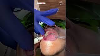 Jaw Expander | Maxillary Jaw Expansion | Rapid Palatal Expansion | Before and After - #shorts #short