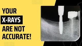 How to make you XRAYS accurate !