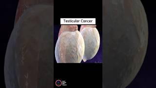 Testicular Cancer