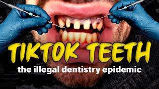 Unlicensed Tiktok 'Veneer Techs' Are IRREVERSIBLY Ruining People’s Teeth