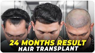 Hair Transplant in Bangalore | Best Results & Cost of Hair Transplant in Bangalore