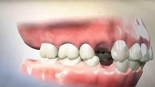 Removing Teeth for Braces - Why  Extracting and Retracting Orthodontics is harmful