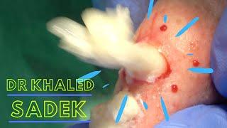 Explosive Jaw Cyst. Dr Khaled Sadek. LipomaCyst.com