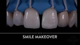 Smile makeover