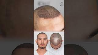 Twenty Five Months Hair Transplant Results | Latest Fue Technique #shorts #viral #hair transplant