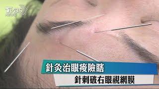 針灸治眼痠險瞎　針刺破右眼視網膜