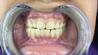 Before and After | In Office | Laser Teeth Whitening | By Dr. Jugal Panchal (Cosmetic Dentist)