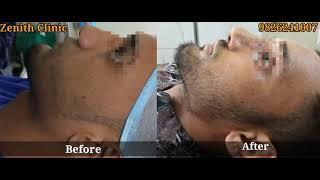 Rhinoplasty Result| Zenith clinic Mumbai Raipur Jaipur Lucknow Delhi Ahmedabad Nagpur Bhopal Indore