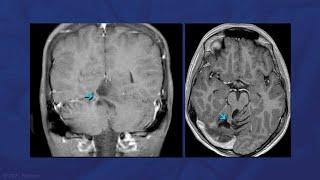 Lateral Supracerebellar Infratentorial Approach for a Recurrent Vermian Cerebellar AVM